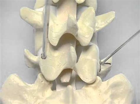 Pedicle Identification_spine surgery - YouTube