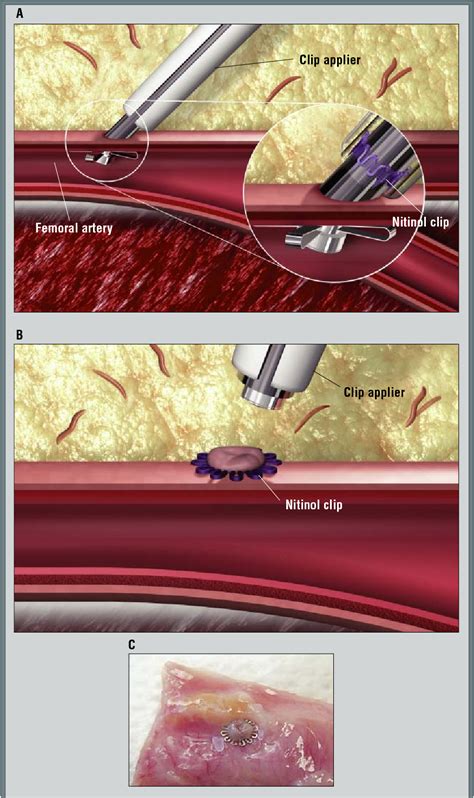 Figure 3 from Femoral artery closure after cardiac catheterization ...