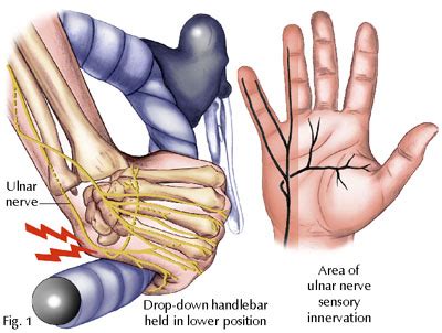 Ulnar Nerve Entrapment