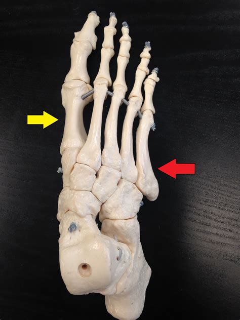 foot bones Jones Fracture - Northern InStride Foot & Ankle Specialists