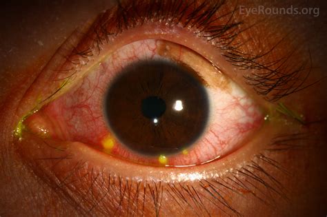 Atlas Entry - Phlyctenular Conjunctivitis