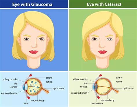 Glaucoma vs. Cataracts: What’s the Difference? - Responsum Health