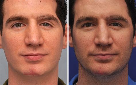 Scar Removal Annapolis MD | Scar Revision Severna Park