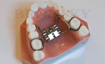 Banded Palatal Expander (PE) | Bronsky Orthodontics