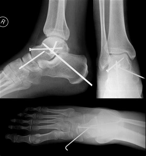 Subtalar dislocation | The Foot and Ankle Online Journal