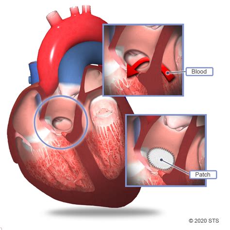 Ventricular Septal Defect Surgery | The Patient Guide to Heart, Lung ...