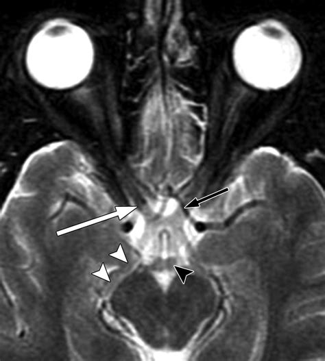 Appearance of Normal Cranial Nerves on Steady-State Free Precession MR ...