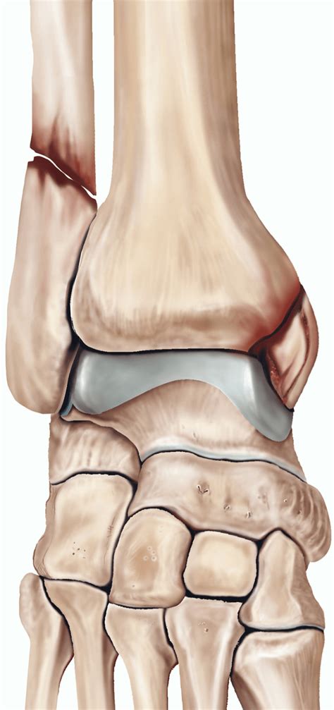 Compound Ankle Fracture Pictures - Foto Kolekcija