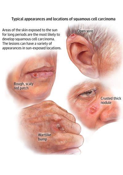 Basal Cell Carcinoma - Richmond Hill Cosmetic Clinic