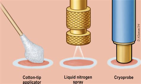 Cryosurgery uses in dermatology | Dermatology Games