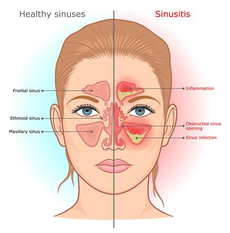 Sinus Infection: Warning Signs And Symptoms When to See a Doctor for ...