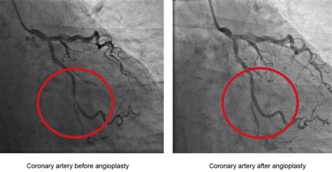 Coronary Angioplasty Specialist in Bangalore, Chennai | Angioplasty ...