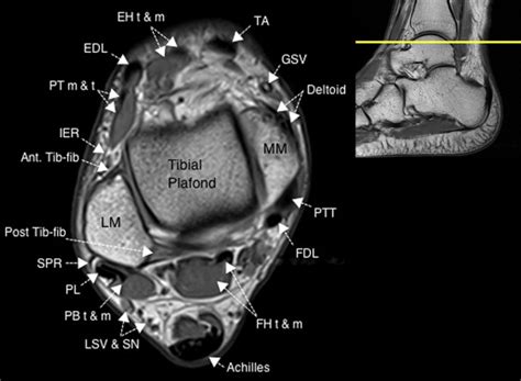 Foot Muscles Mri Anatomy / anatomy of hip joint | free MRI coronal ...