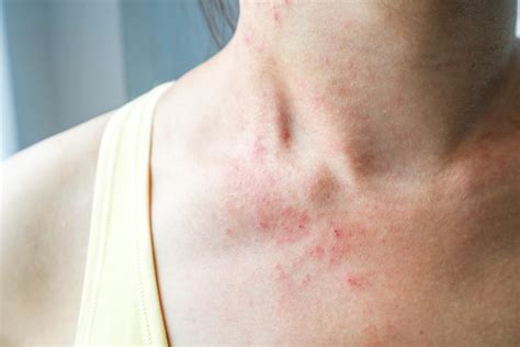 A rash is a common symptom of anxiety