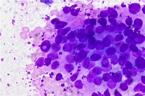 Papillary Thyroid Carcinoma, FNA, Giemsa stain | Ed Uthman | Flickr