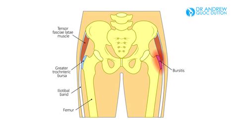 Right Hip Bone Pain Causes You Should Know - DeeahZone | Informasi dan Tips