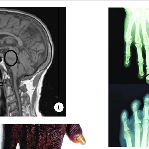 Magnetic resonance imaging (MRI) of the brain showing pontine infarct ...