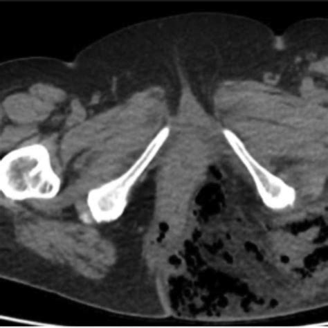 Left-sided hydronephrosis 6 months prior to presentation. (A ...