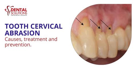 Tooth Cervical Abrasion, Causes, Treatment and prevention - Best Dental ...