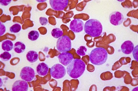 Leukemia | Definition, Causes, Symptoms, & Treatment | Britannica