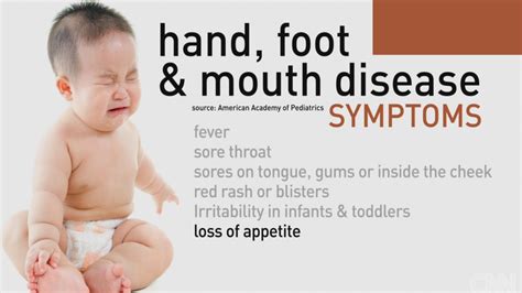 Hand Foot Mouth Disease Stages