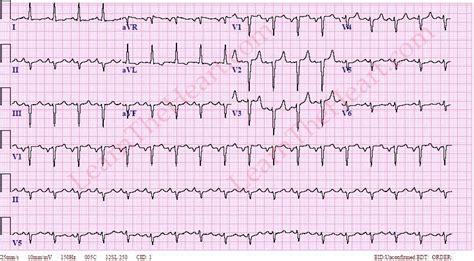 Left Atrial Enlargement ECG Example 1 | LearntheHeart.com