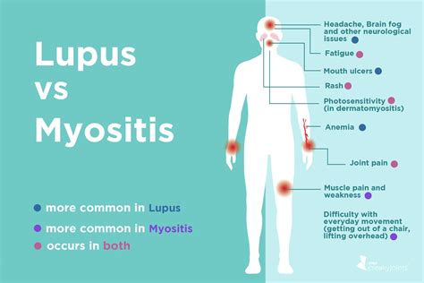 Lupus vs. Myositis: Differences in Symptoms and Treatments