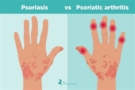 Psoriasis and Psoriatic Arthritis: What’s the Connection?