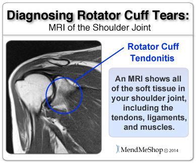 How Do I Diagnose a Torn Rotator Cuff? One way is through an MRI ...