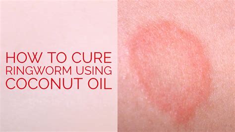 How to Cure Ringworm using Coconut Oil