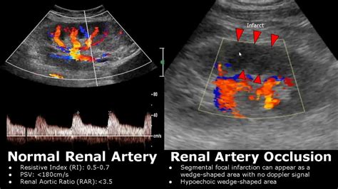 Renal Artery Doppler Ultrasound Normal Vs Abnormal Images | Stenosis ...