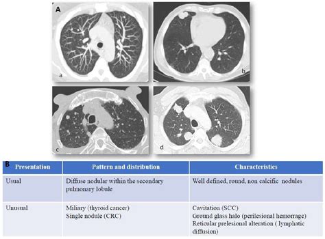 Lung Cancer Metastasis Symptoms