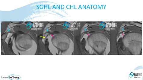 GLENOHUMERAL LIGAMENTS MRI ANATOMY: SUPERIOR GLENO HUMERAL LIGAMENT ...