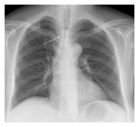 Chest X-ray with tracheal stent in place. | Download Scientific Diagram