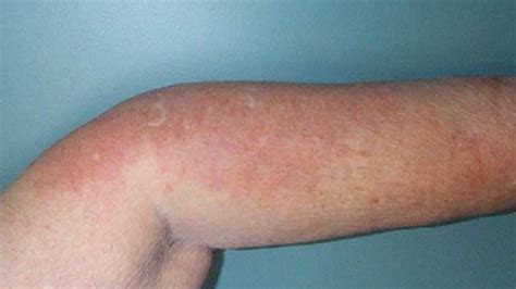 Rheumatoid Arthritis Rashes: Pictures, Symptoms, and Treatments