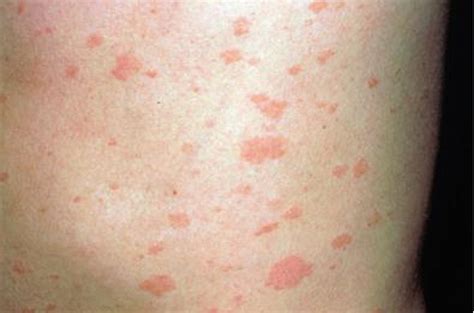 Ehrlichiosis - Causes, Symptoms, Rash, Diagnosis, Treatment