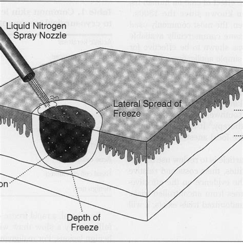 (PDF) Cryosurgery for common skin lesions. Treatment in family ...