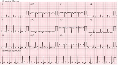 Electrocardiogram (ECG) – Bayside Medical Group