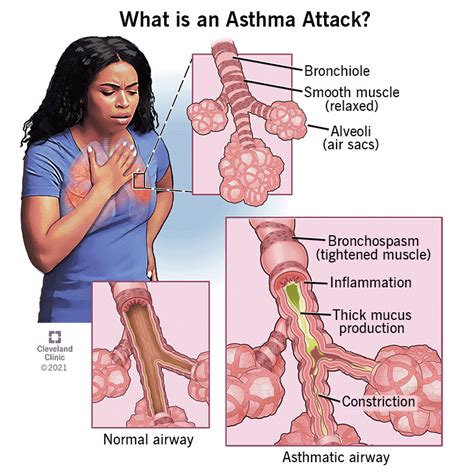 Asthma: Management, prevention and treatment – Tamhane Clinic