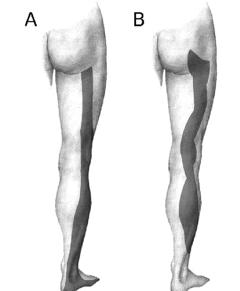 Examples of dermatomal patterns of radicular sciatica of S1 (A) and S2 ...