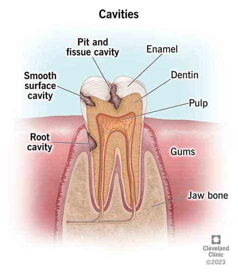 Cavities (Tooth Decay): Symptoms, Causes & Treatment