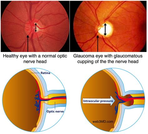 glaucoma-cupping-of-nerve-head - Fort Worth Eye Associates