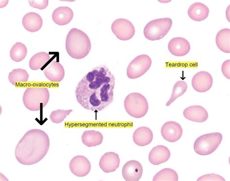 Laboratory Diagnosis of Megaloblastic Anemia (MBA)