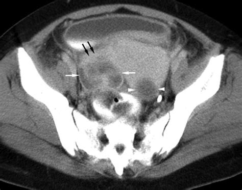 Tubo Ovarian Abscess Treatment