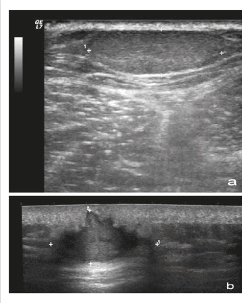 [PDF] Ultrasound for diagnosis of soft-tissue lipoma : accuracy and ...