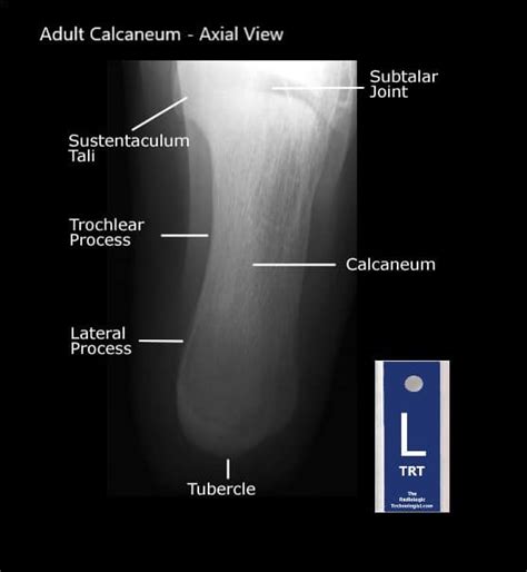 Student Study Guide: Calcaneus Anatomy