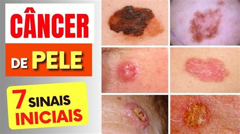 7 SINAIS de Alerta para CÂNCER DE PELE que Todos Deveriam Saber (e ...