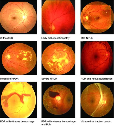 Stages of diabetic retinopathy | Download Scientific Diagram