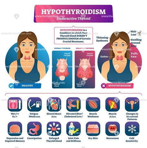 Hormone Therapy for Thyroid Disease