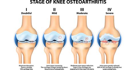 Osteoarthritis diagnosis - the stages of OA explained